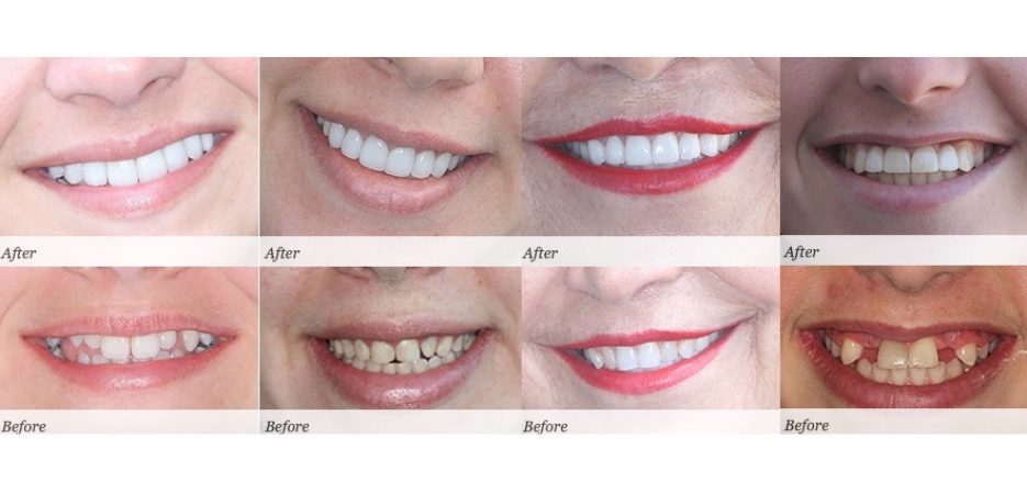Smile Like You Paid for It! The Cost of Teeth Whitening
