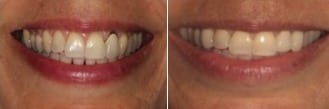 ¿Cuanto cuesta el blanqueamiento de dientes? | Antes y después del blanqueamiento dental, cortesía de Eisdorfer Dental Group